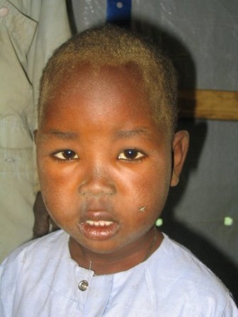  Nephrotic_Syndrome (11).jpg